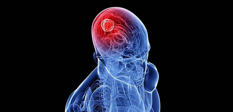 Symptoms of Brain Tumors