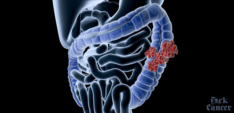 What is Colorectal Cancer?
