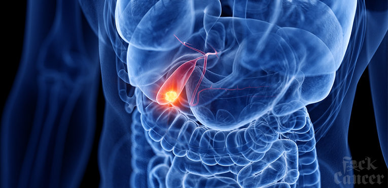 Gallbladder Cancer – What is it?