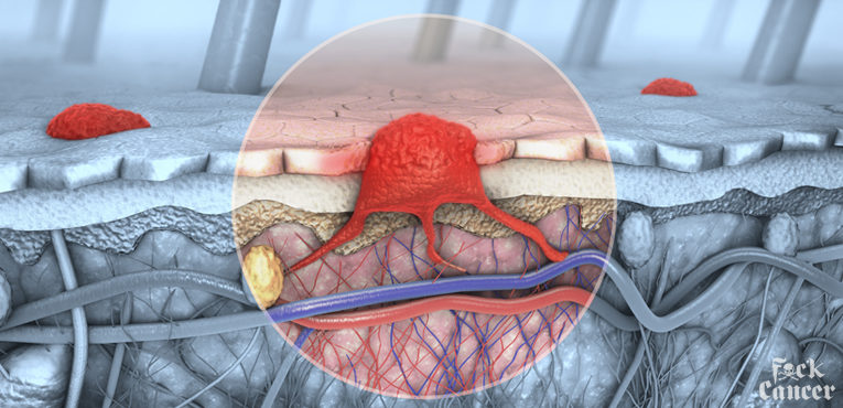 Melanoma Skin Cancer Awareness