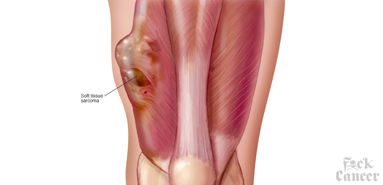 Soft Tissue Sarcoma Awareness