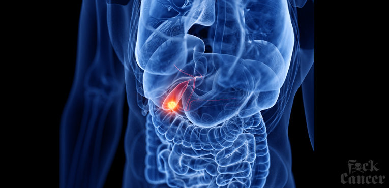 Gallbladder Cancer // Overview