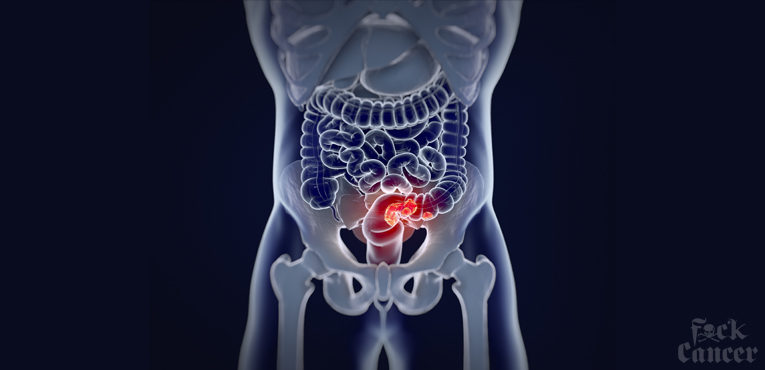 Colorectal Cancer // Signs, Symptoms, and Screenings