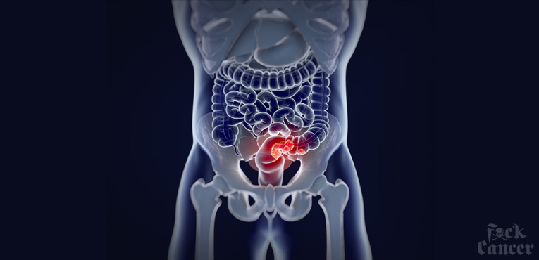 Colorectal Cancer // Signs, Symptoms, and Screenings