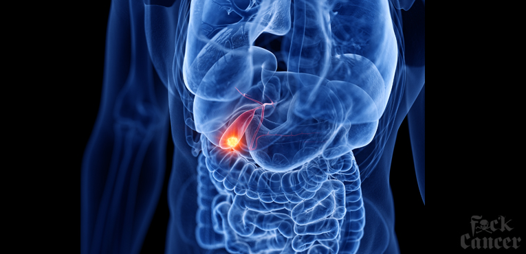 gallbladder cancer image